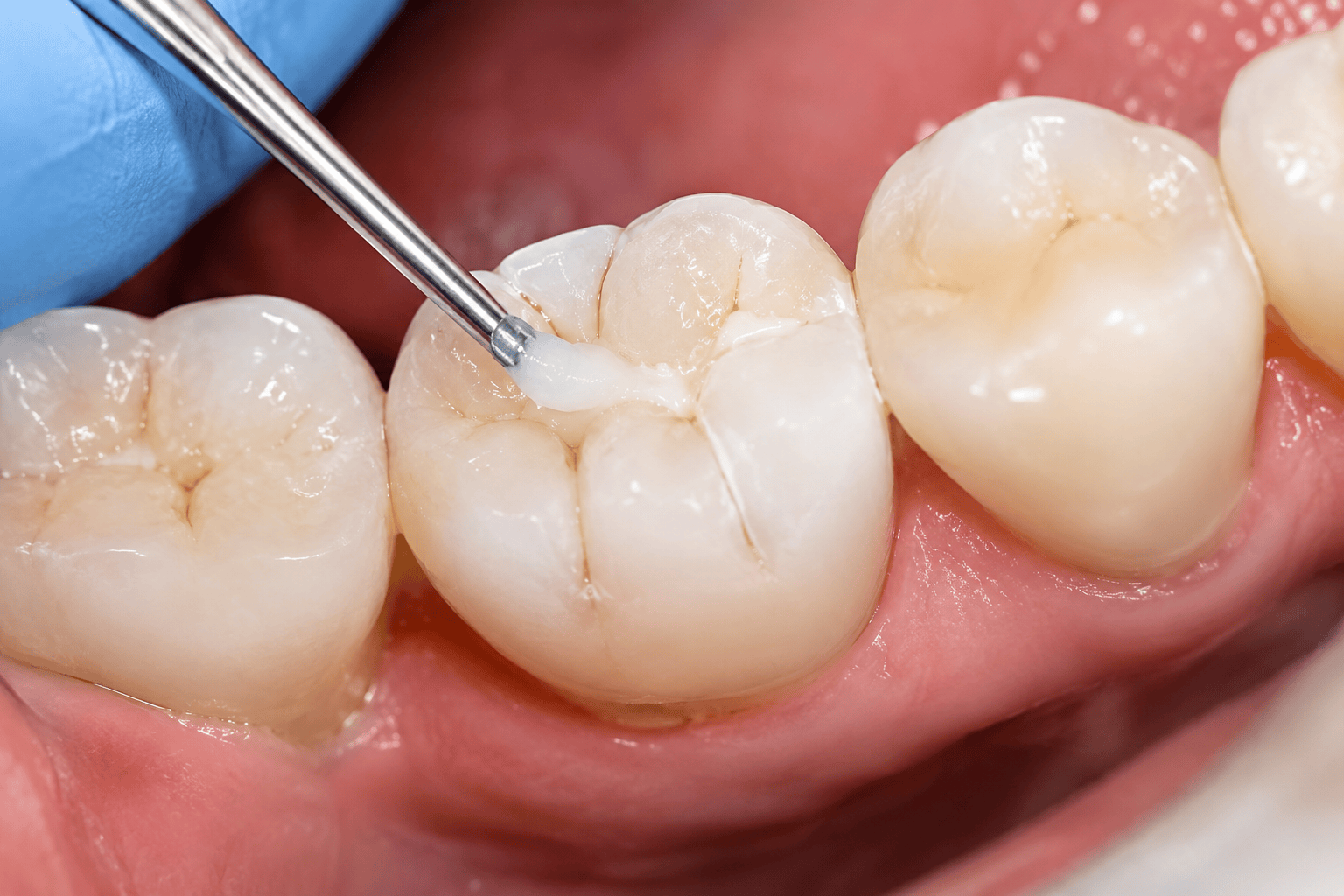 VP Dental Clinic Dental Restoration Services