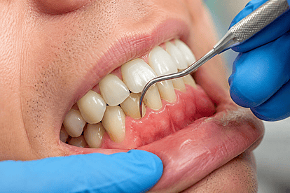 VP Dental Clinic Dental Periodontics Services